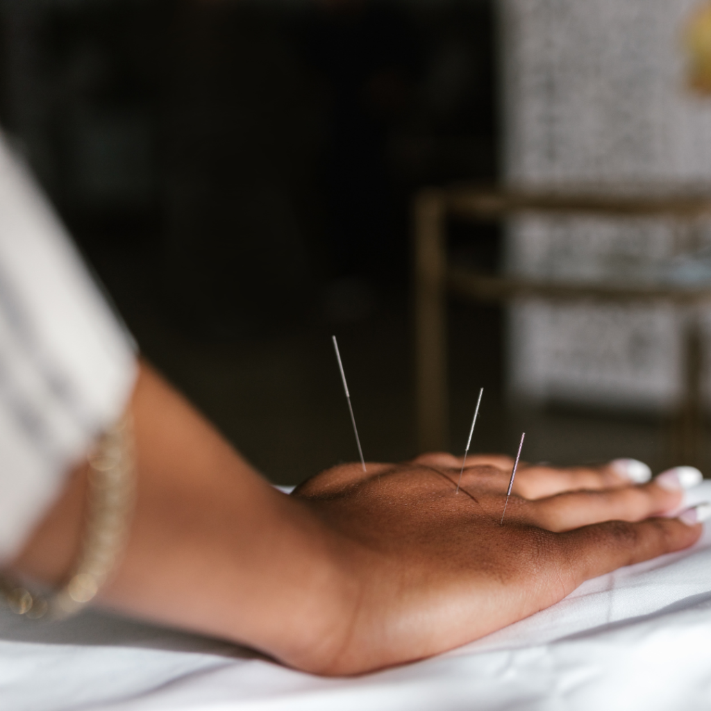 A Person Having an Acupuncture Treatment